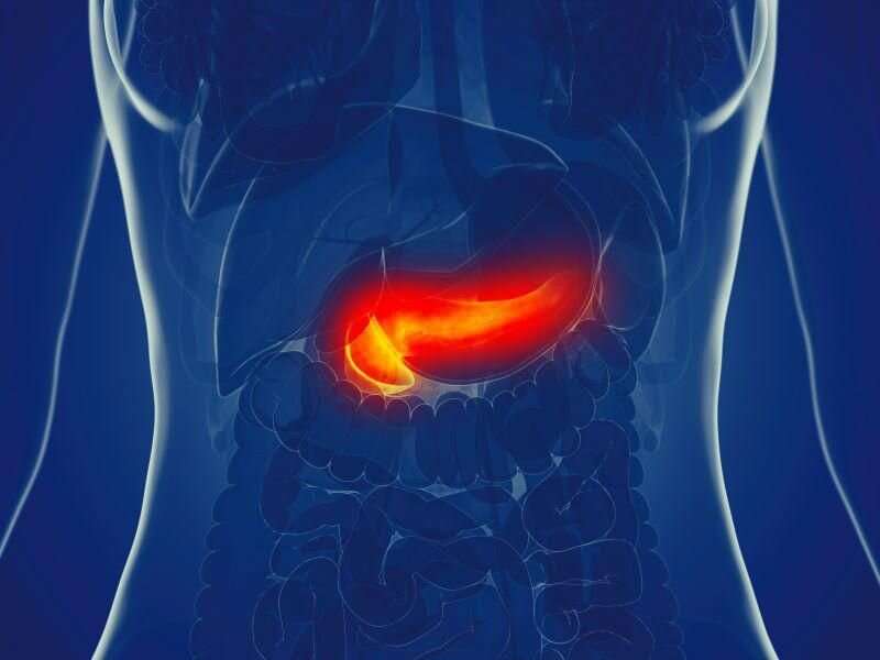 Endoscopic drainage better for necrotizing pancreatitis