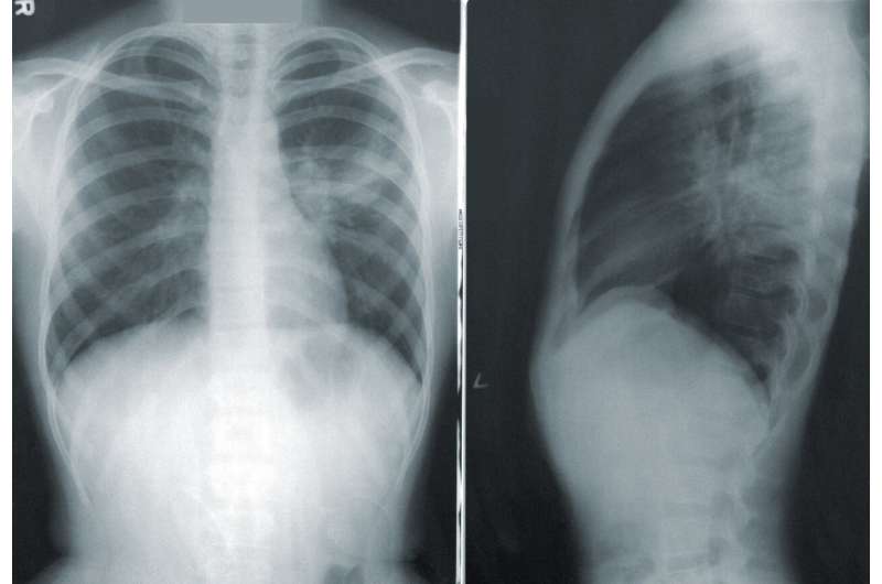 Study offers insight into management of patients who have interstitial pneumonia with autoimmune features 