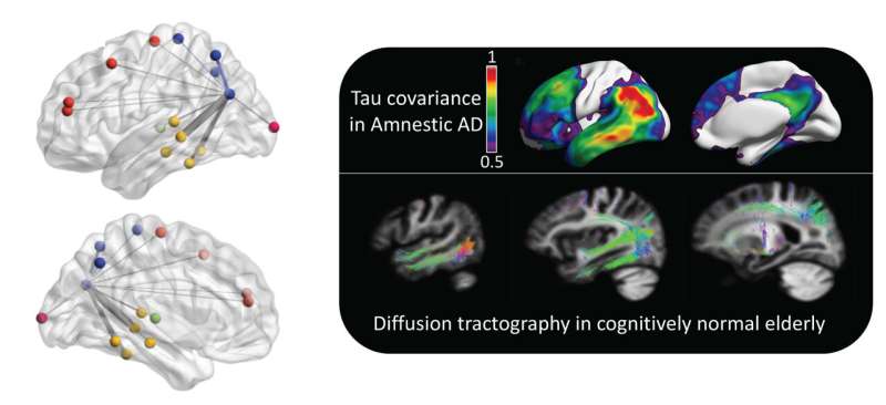 A telltale protein spreads throughout the brain in distinct patterns based on patients' Alzheimer's phenotype