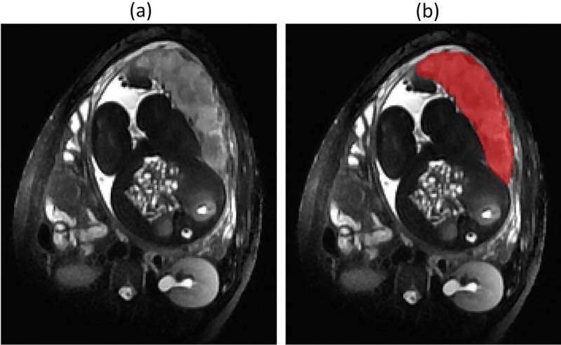 Pandemic stress reshapes the placentas of expectant moms 