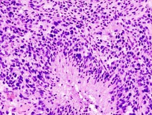 Glioblastoma (histology slide). Credit: Wikipedia/CC BY-SA 3.0