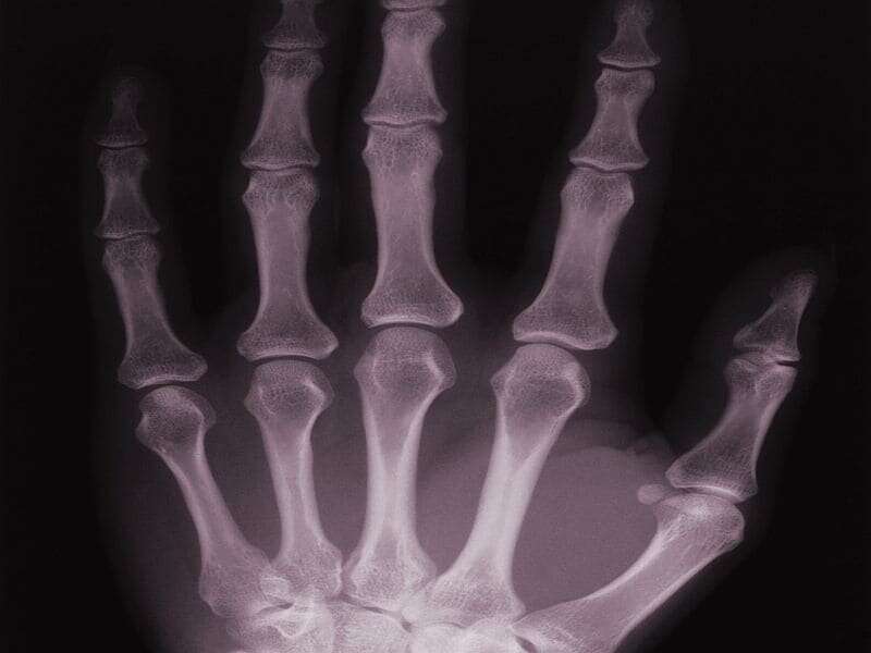 Serum IL-35 levels tied to bone loss with rheumatoid arthritis 