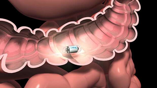 Colon capsule endoscopy: Reshaping bowel cancer diagnosis 