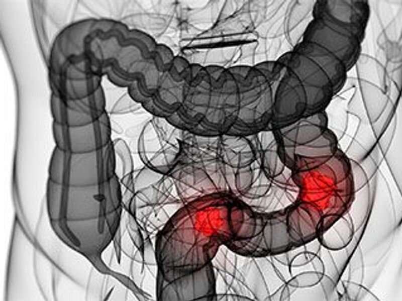 Additional biopsies after colorectal cancer biopsy not tied to metachronous colorectal cancer 