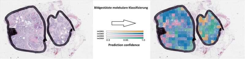 Researchers use AI to establish molecular tumor classification and prognosis in patients with colorectal cancer