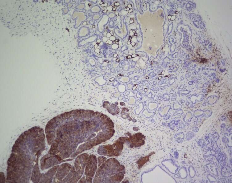 Researchers describe a molecular strategy that helps prevent tumour formation in mice