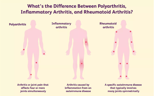 Polyarthritis, Inflammatory Arthritis, and Rheumatoid Arthritis