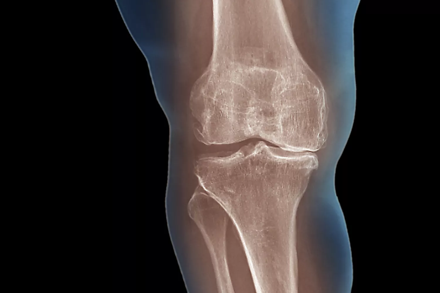 Osteoarthritis (Degenerative Arthritis): Symptoms and Treatment