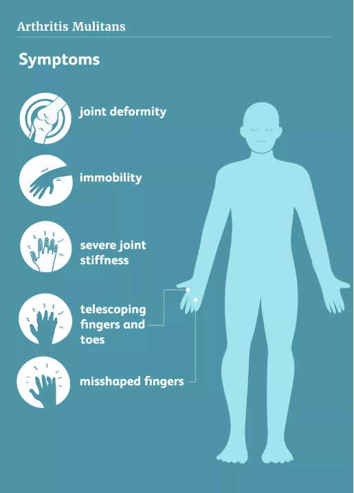 An Overview of Arthritis Mutilans