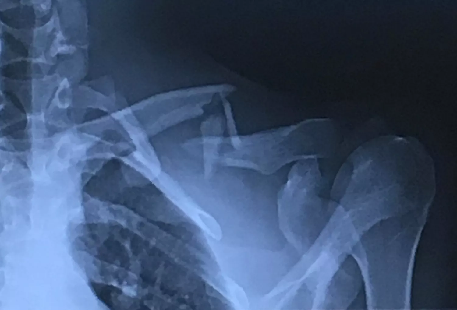 Clavicle Fracture Treatment: When Is Surgery Necessary?