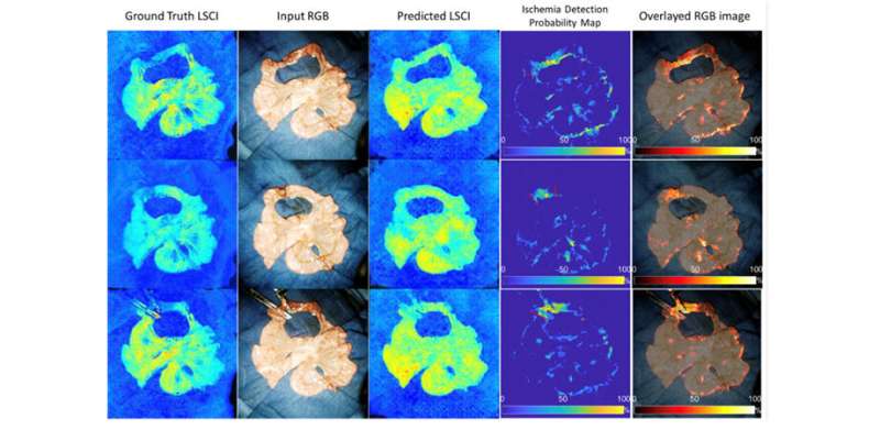 Quantitative diagnosis of bowel ischemia with deep learning