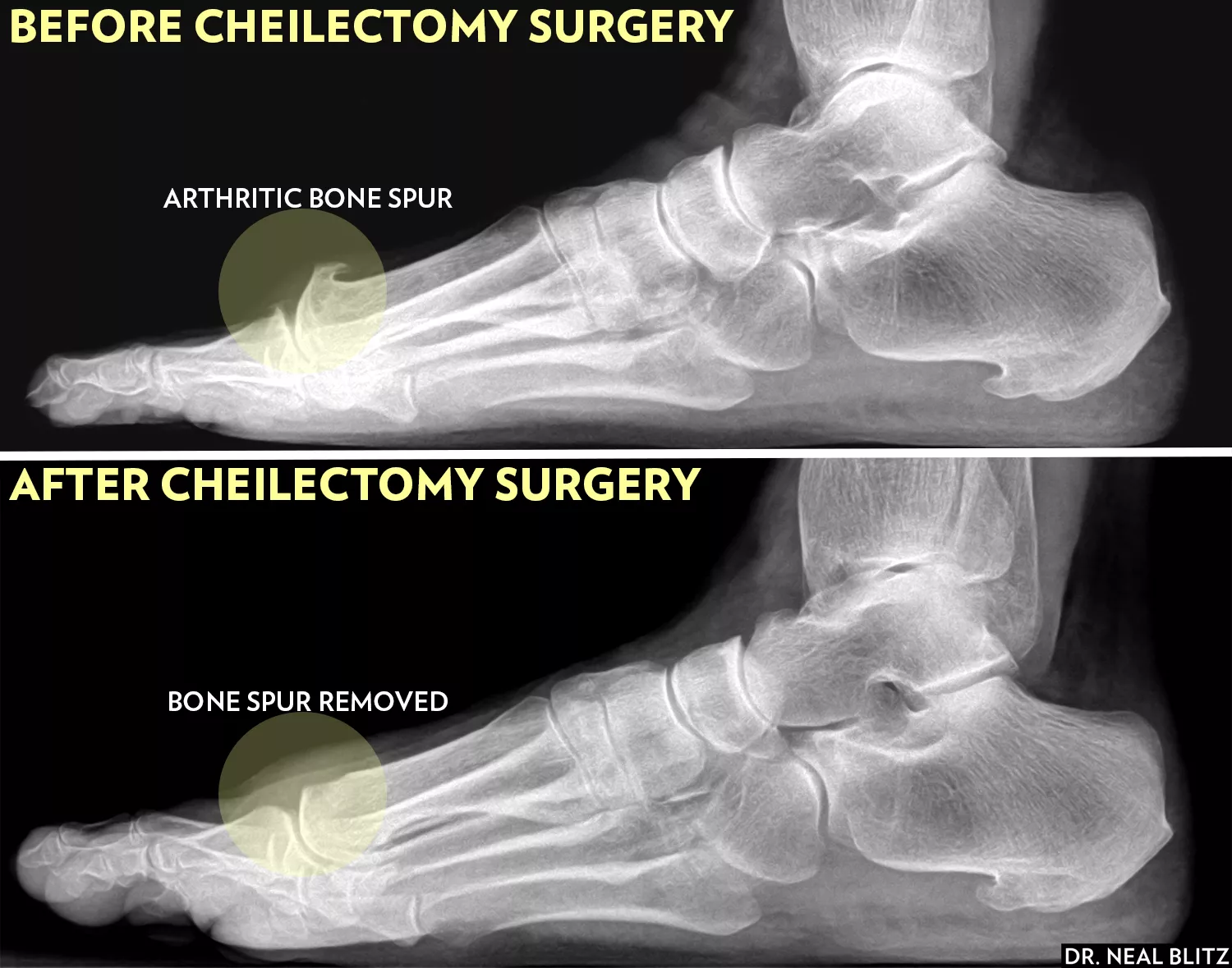 What to Know About Big Toe Bone Spur Surgery (Cheilectomy)