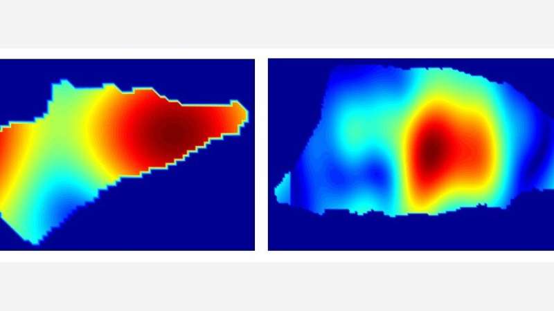 Researchers to develop handheld device to diagnose skin cancer 