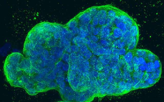 Researchers to test novel drug combination against toughest breast cancers 