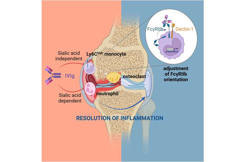 How intravenous immunoglobulin antibodies resolve joint inflammation in rheumatoid arthritis 