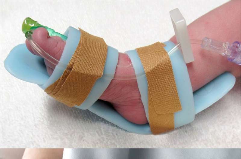 Skin injuries to babies in neonatal care could be avoided with new splint, trial shows 