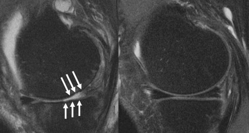 Steroid injections worsen knee arthritis, according to two new studies 