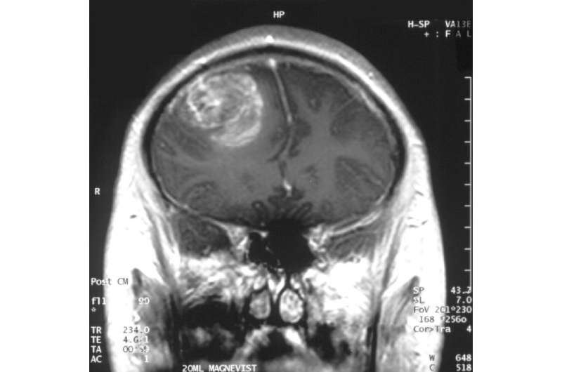 Researchers find a new promising therapeutic target for glioblastoma 