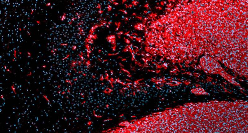 Researchers discover the Achilles' heel of an aggressive brain cancer 