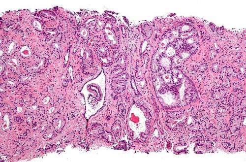 Researchers create a drug to extend the lives of men with prostate cancer 