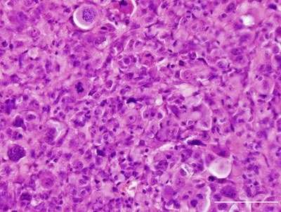 Researchers clarify role of mutations in glioblastoma