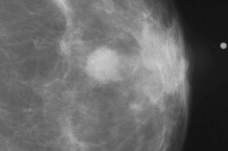 AI model predicts breast cancer risk without racial bias