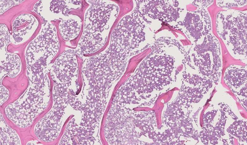 A microscopic image of intramedullary osteosarcoma. Johns Hopkins researchers have trained a machine learning model use such images to calculate percent necrosis—or, what percentage of a tumor is "dead" and no longer active—in patients with intramedullary osteosarcoma. Credit: Johns Hopkins Medicine