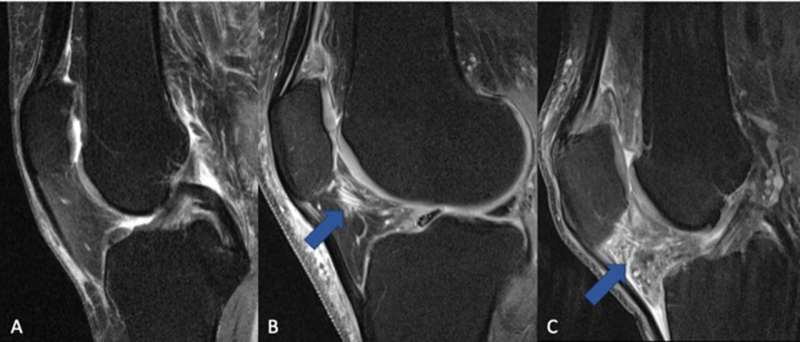 NSAIDs may worsen arthritis inflammation