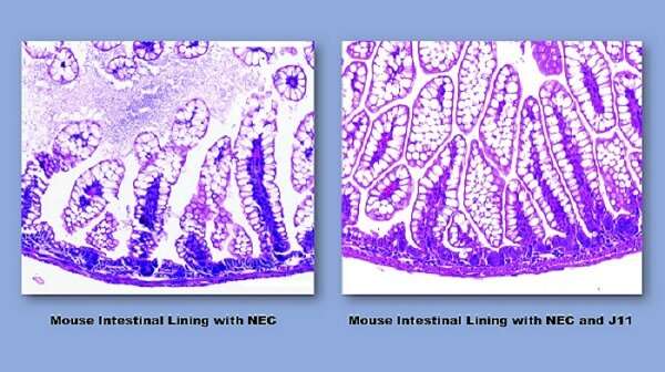 Researchers define chain of events leading to dangerous intestinal disorder in preemies