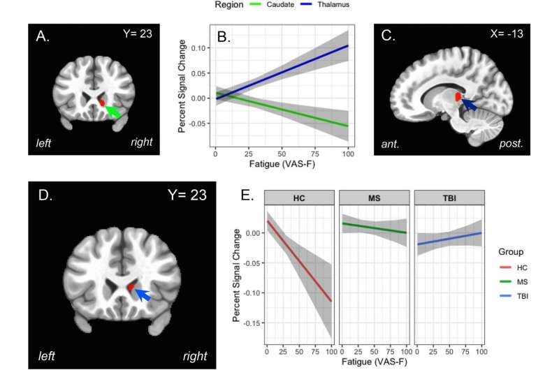 The effects of cognitively fatiguing tasks on brain activation. (A) The location in the caudate of brain activation showing the main effect of CF (green arrow). (B) The significant negative relationship between the CF (VAS-F scores) and brain activation in the caudate nucleus (green line) and the significant positive relationship between CF and brain activation in the thalamus (dark blue line). (C) The location of thalamic brain activation showing the main effect of CF (dark blue arrow). (D) The location of brain activation showing at interaction between Group (HC, MS and TBI) and CF: the caudate nucleus of the basal ganglia (blue arrow). (E) Activation in the caudate nucleus as a function of CF for each of the three groups; Controls are shown in red, the MS group in green and the TBI group in blue. For panels B and E the shaded areas represent 95% confidence intervals. Credit: Scientific Reports (2023). DOI: 10.1038/s41598-023-46918-y