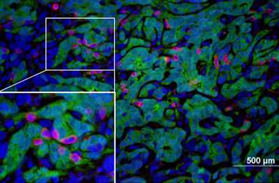 Study reveals secrets of "hot" and "cold" pancreatic cancer tumors 