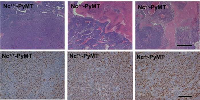 Research targets metformin as breast cancer prescription 