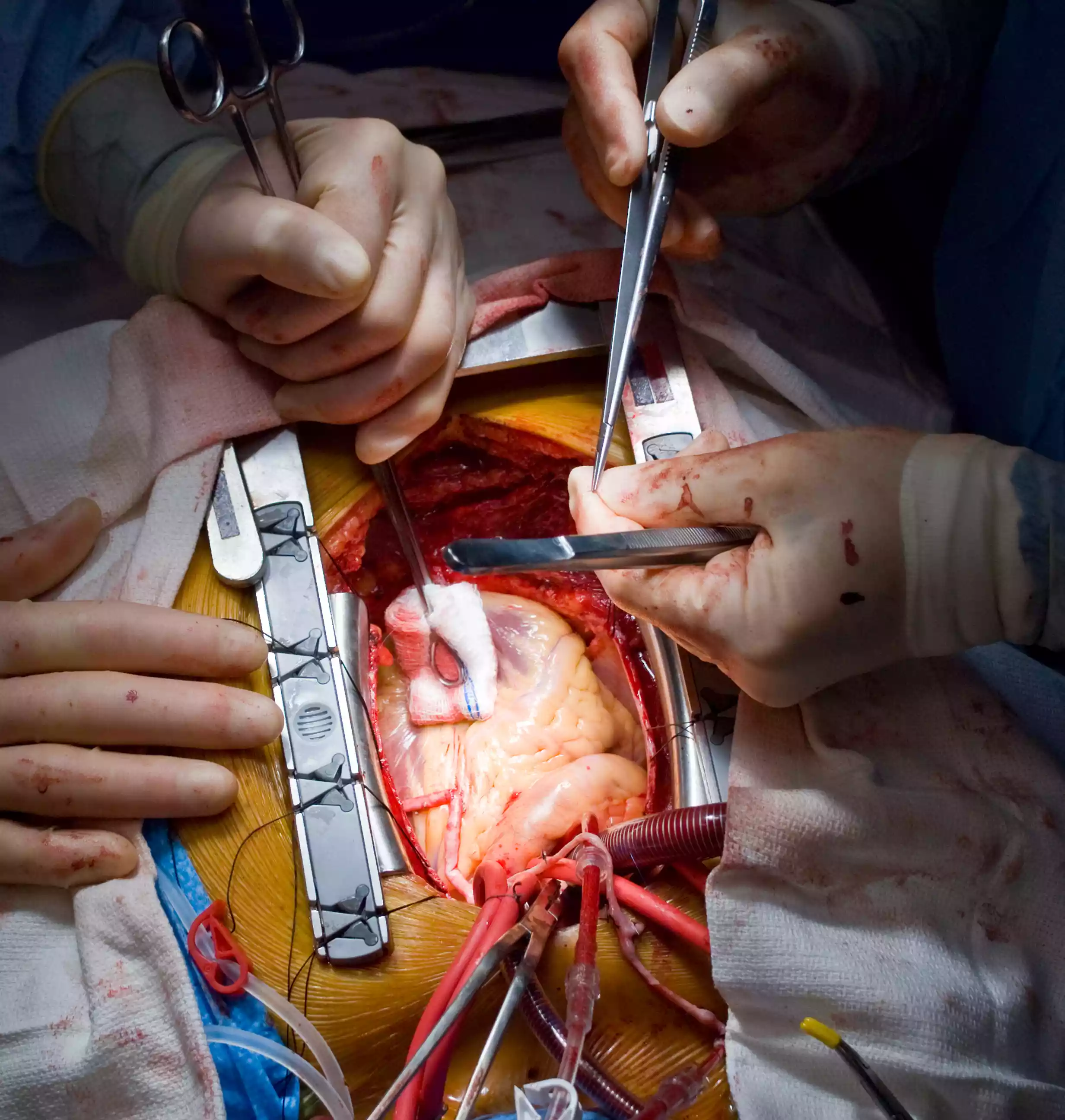 Vascular Surgery: Overview