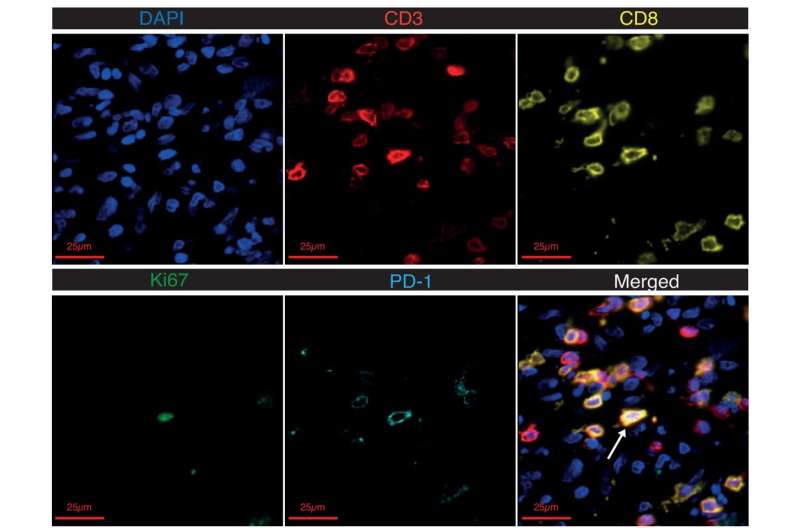 Unique immune response found in patients who experience inflammatory arthritis as side effect of cancer therapies