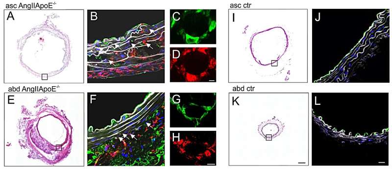 Researchers investigate why aortic aneurysms form at the arch or in the abdominal segment