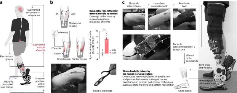 A prosthesis driven by the nervous system helps people with amputation walk naturally