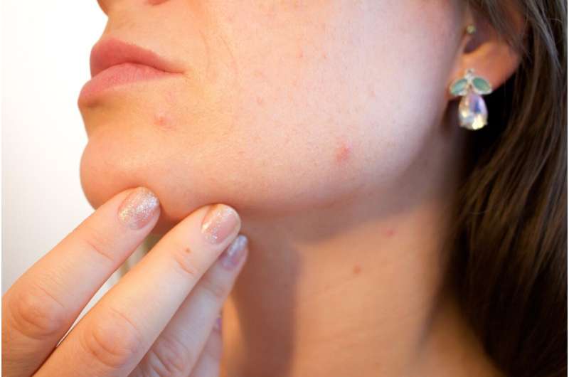 Omega-3 fatty acid intake may lessen acne severity