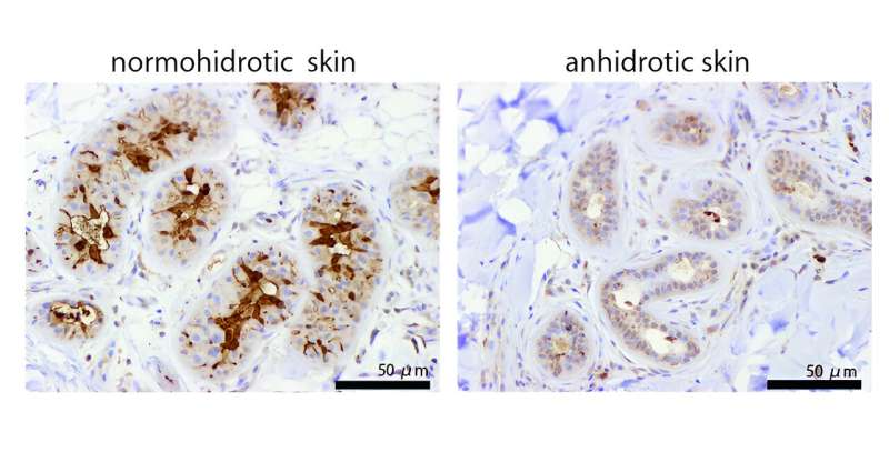 Study examines role of the gene TRPV4 in regulating perspiration in mice