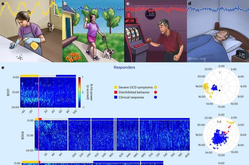 Researchers discover a new neural biomarker for OCD