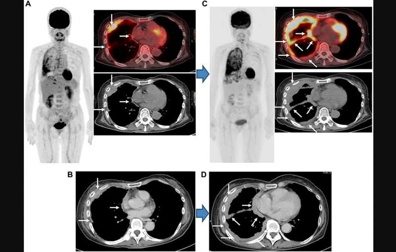 Comparison of FDG-PET/CT and CT for treatment evaluation of patients with unresectable malignant pleural mesothelioma