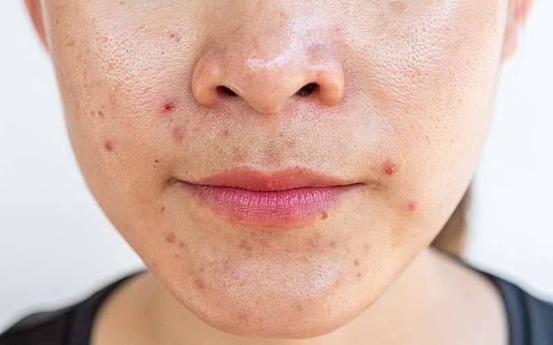 Direct calcitonin gene-related peptide inhibition found to reduce acne, rosacea in patients with migraine