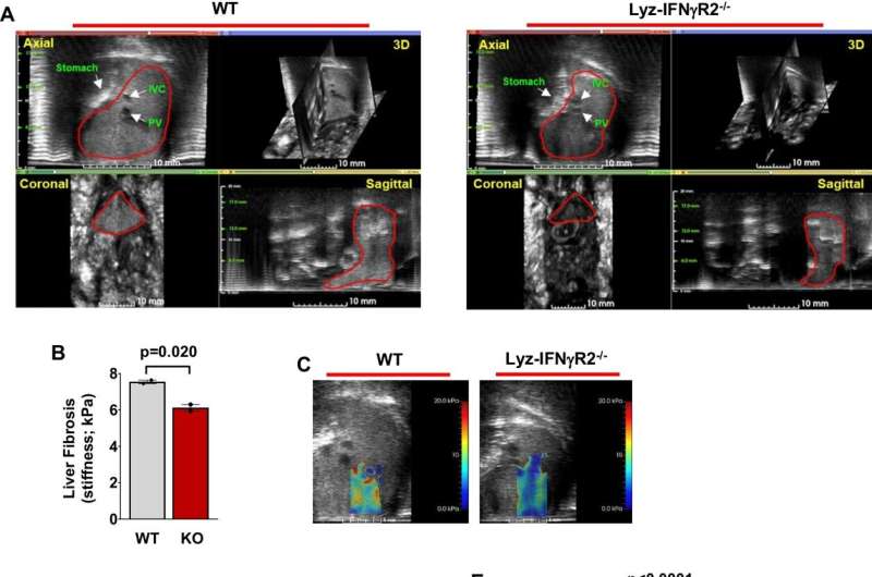 Novel pathway could lead to potential treatment for metabolic liver disease