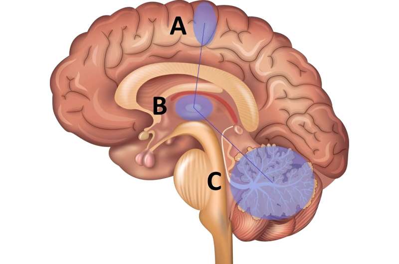 Trouble with trembling hands originates in the brain: Research IDs genetic variations associated with essential tremor