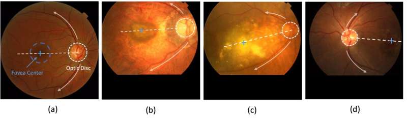 Retinal disorder diagnosis improved by new AI-powered medical imaging, study shows