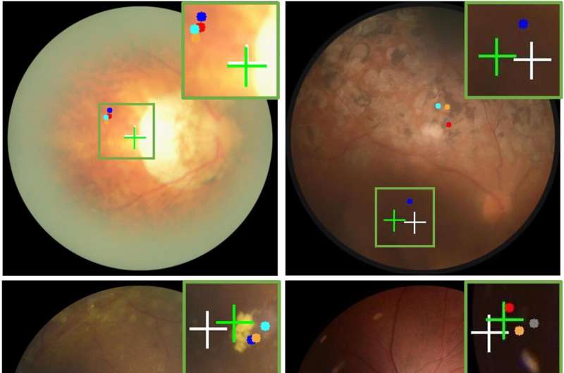 Retinal disorder diagnosis improved by new AI-powered medical imaging