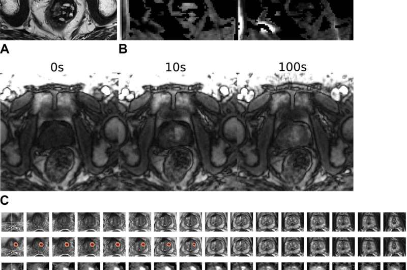 AI model effective in detecting prostate cancer