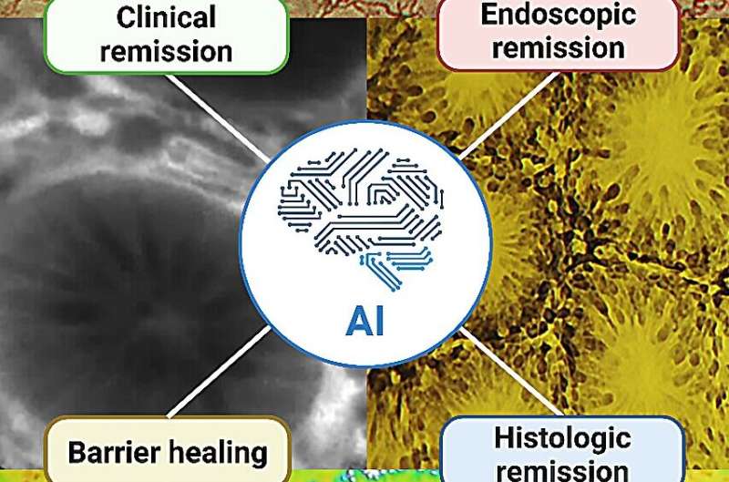 AI shows promise for precision inflammatory bowel disease management