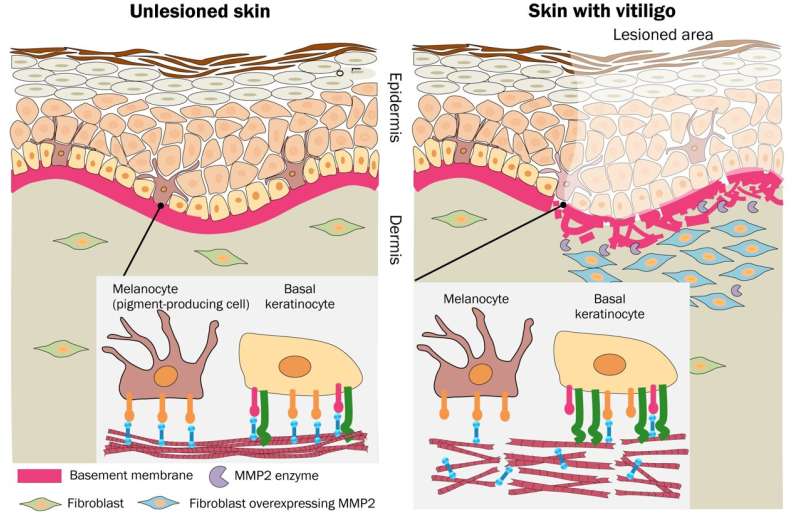 Vitiligo: Loss of skin's pigment-producing cells could be related to basement membrane disruption