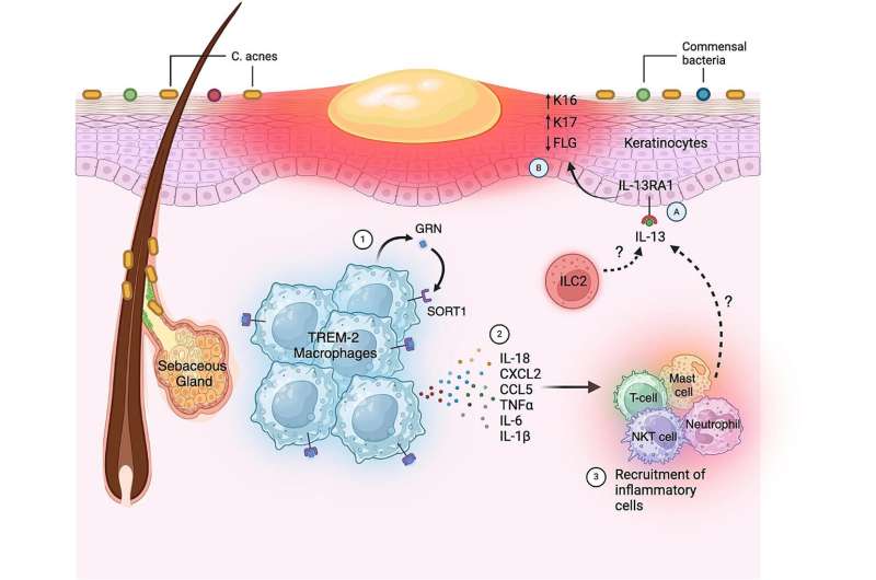 Researchers identify cellular pathways whose dysregulation leads to acne lesions