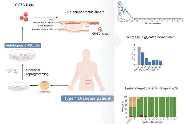 Patient with diabetes type I functionally cured using stem cell injections